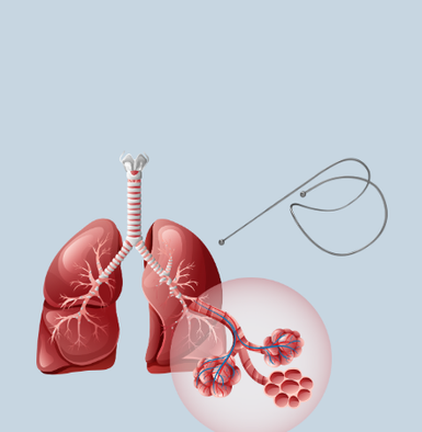 Volutam Helix Endobronchial Coil